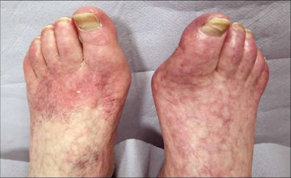 Illustration of critical limb ischemia (CLI) showing severely reduced blood flow to the foot and toes