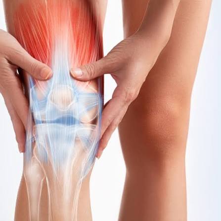 Diagram of a knee affected by osteoarthritis, showing worn cartilage and joint inflammation treated with genicular artery embolization