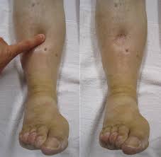 Image of a swollen lower leg with edema caused by fluid buildup and venous insufficiency