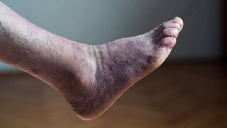 Illustration of poor circulation in the legs showing reduced blood flow through narrowed arteries