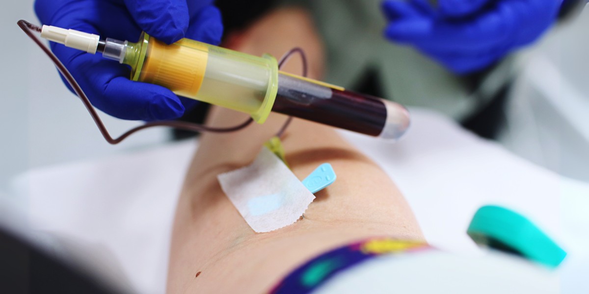How To Remove Trapped Blood After Sclerotherapy?