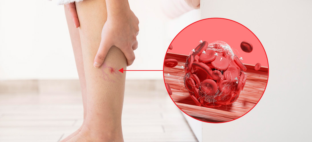 How Do You Reverse Venous Insufficiency In A Short Time?