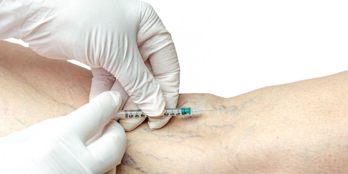 How Much Does Sclerotherapy Cost?
