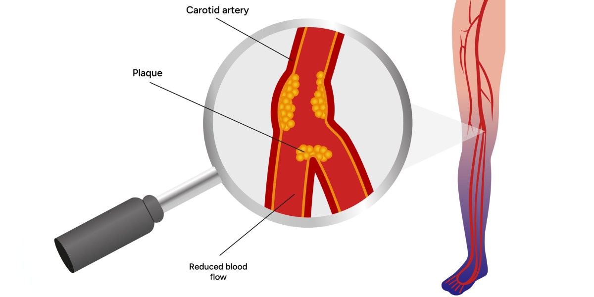 Types Of Peripheral Artery Disease Explained