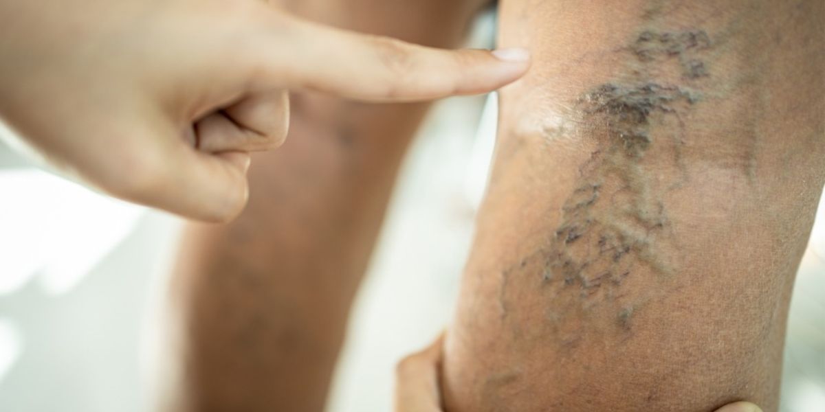 What Type Of Doctor Treats Venous Insufficiency?