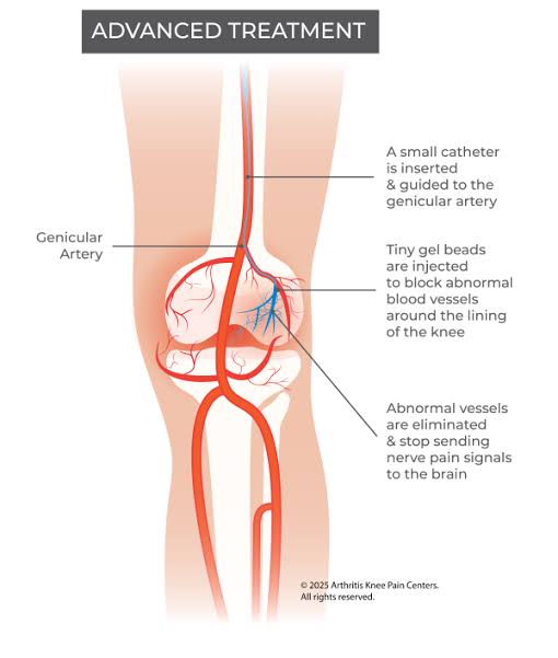 Genicular Artery Embolization (GAE)