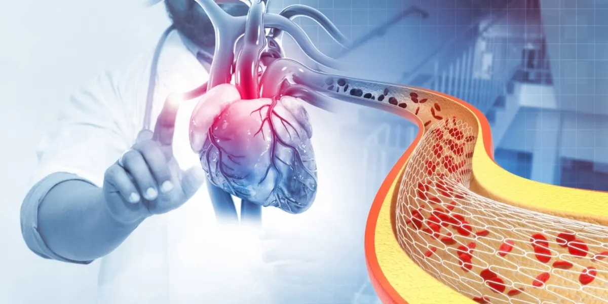 How Much Does Angioplasty Cost?