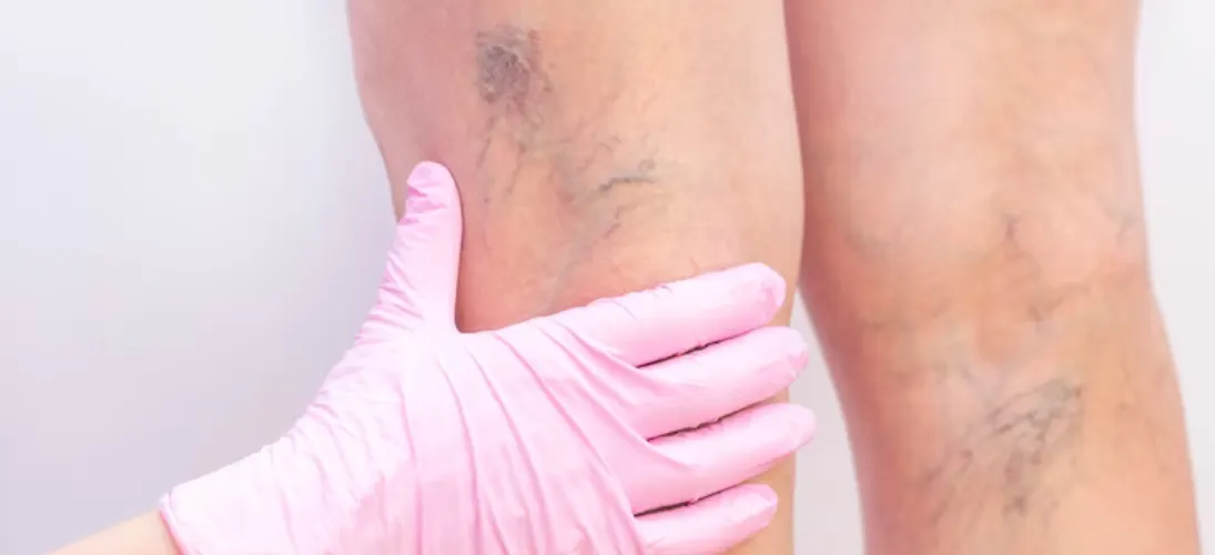 Spider Veins vs Varicose Veins: What's The Difference?