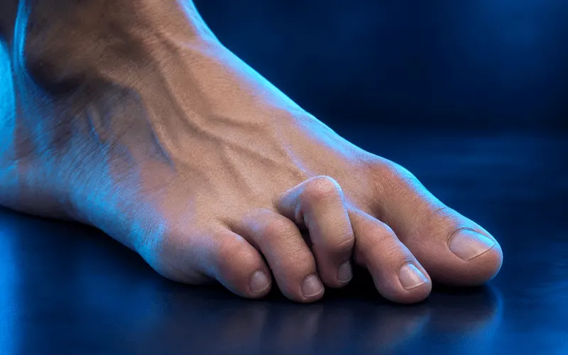 Hammertoes