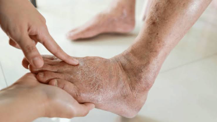 Skin Discoloration on the Legs