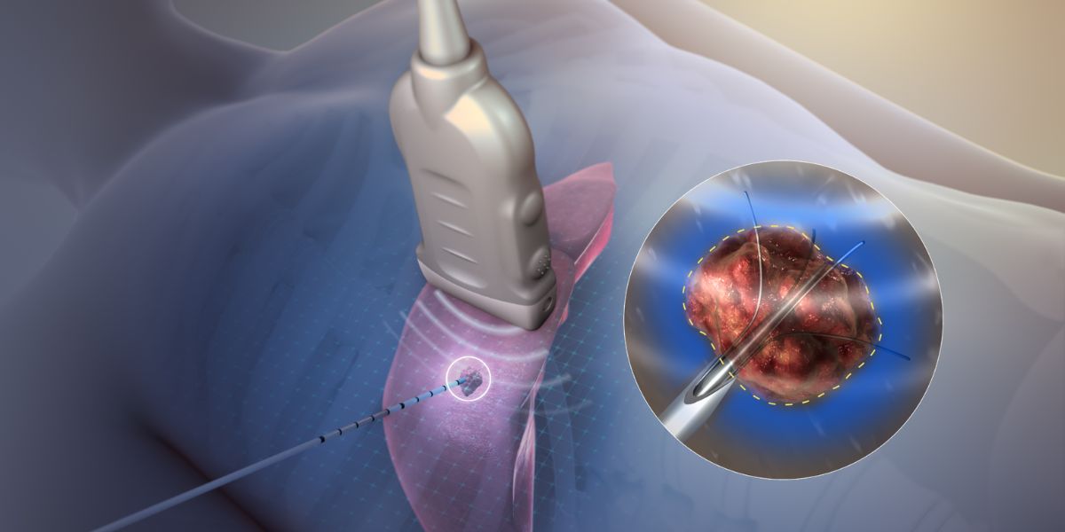 Radiofrequency ablation prices